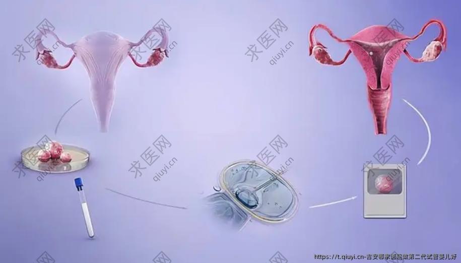 吉安哪家医院做第二代试管婴儿好