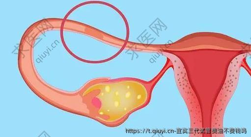 宜宾三代试管费油不费钱吗