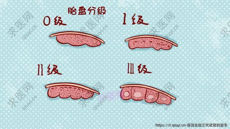 普洱去做三代试管的要求
