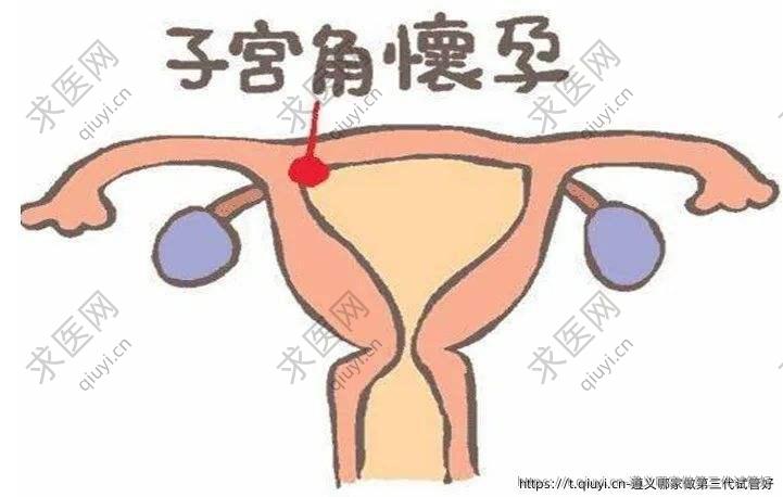 遵义哪家做第三代试管好