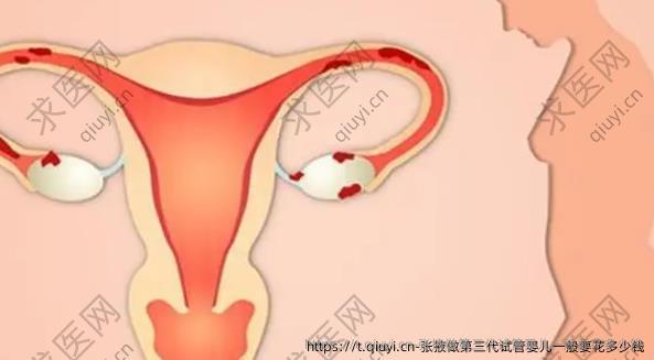 张掖做第三代试管婴儿一般要花多少钱