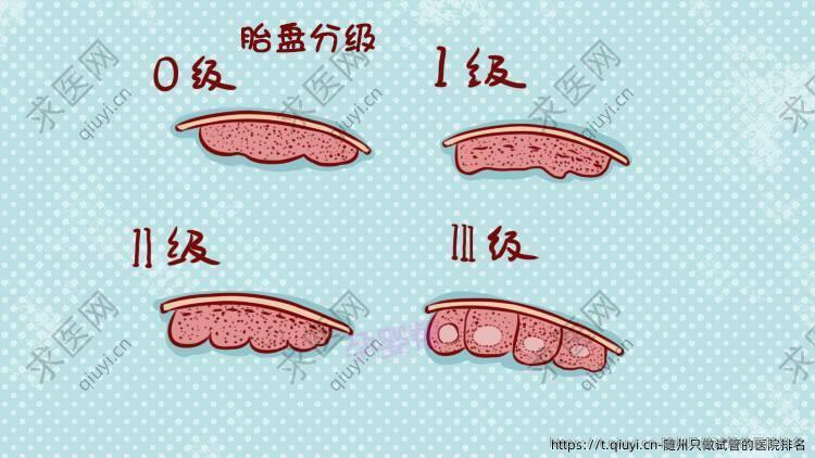 随州只做试管的医院排名