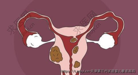 天津第三代试管婴儿要求高吗
