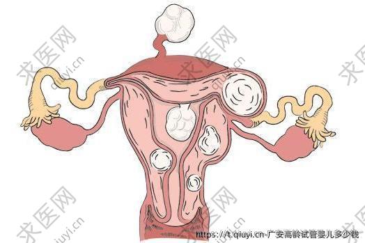 广安高龄试管婴儿多少钱
