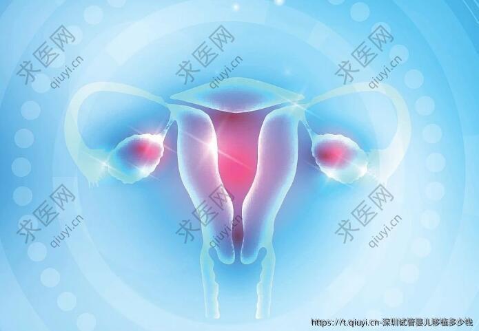 深圳试管婴儿移植多少钱