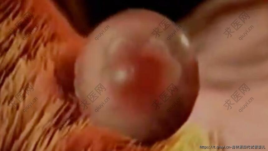 吉林第四代试管婴儿