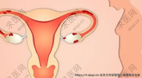 北京三代试管婴儿费用和成功率