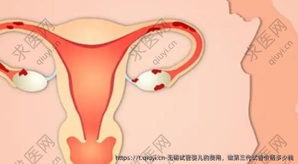 无锡试管婴儿的费用,做三：代试管价格多少钱