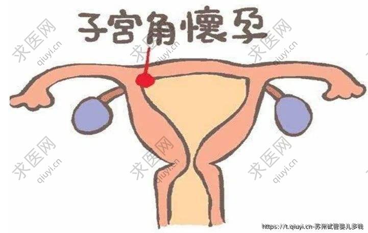 苏州试管婴儿多钱